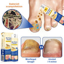 Bivänspray mot psoriasis