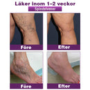 Polidocanol Nano Åderbråcksplåster