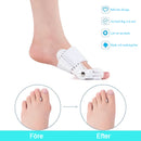 Hallux valgus-korrigerare 🔥Rekommenderad av läkare🔥 för män och kvinnor