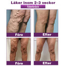 Polidocanol Nano Åderbråcksplåster