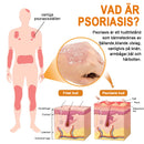 Bivänspray mot psoriasis