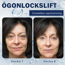 Kräm mot påsar - 💖Köp 1, få 1 gratis (2 st)💖