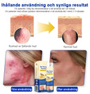 Bivänspray mot psoriasis