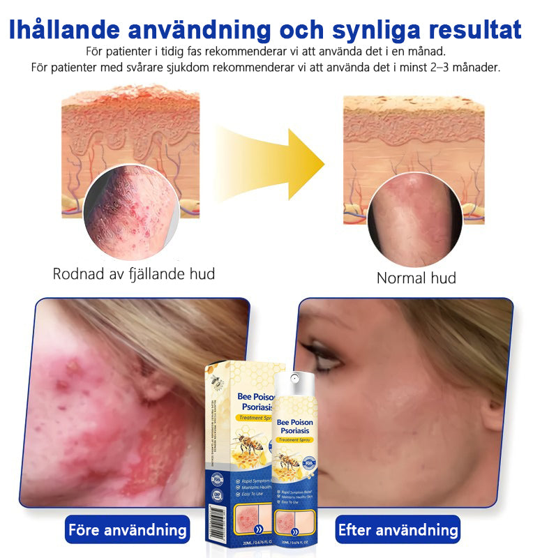 Bivänspray mot psoriasis