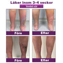 Polidocanol Nano Åderbråcksplåster