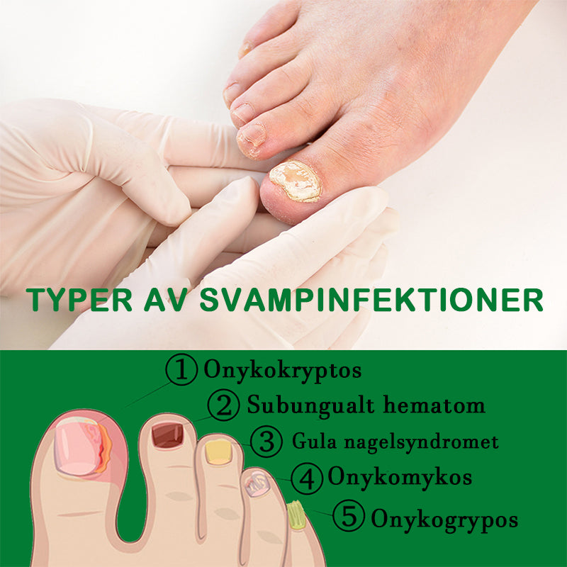 Nagelvård med ingefära