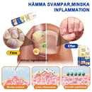 Bivänspray mot psoriasis