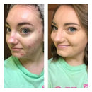 Tre-tonig hyklorekorrigerare